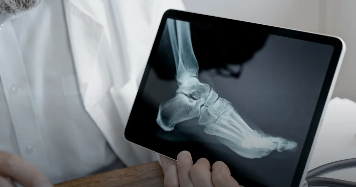 βEat less, run fasterβ: how an energy deficit breaks a runner's bones